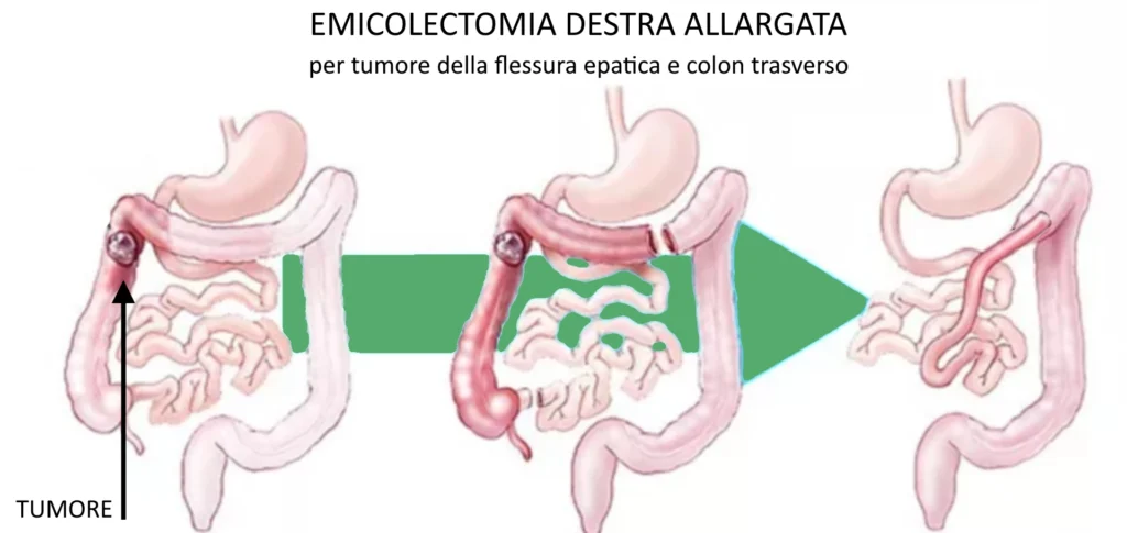 grafica per emicolectomia destra allargata