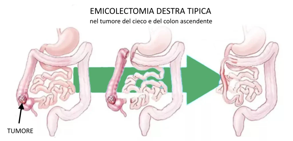 grafica per emicolectomia destra tipica