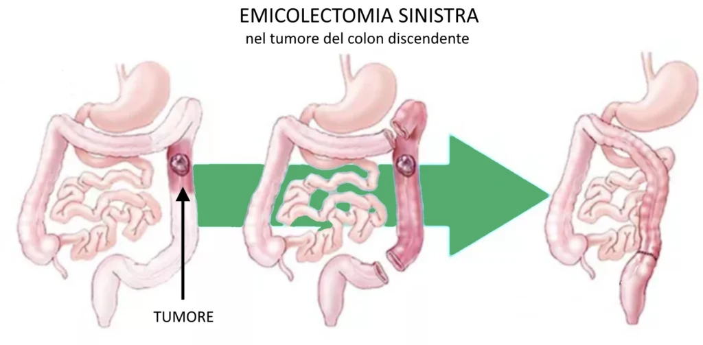 grafica per emicolectomia sinistra